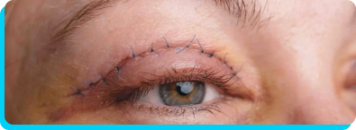 Blefaroplastia em Rio Branco